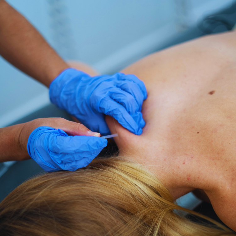 Dry needling. Fysiotherapie. Fysio en Motion