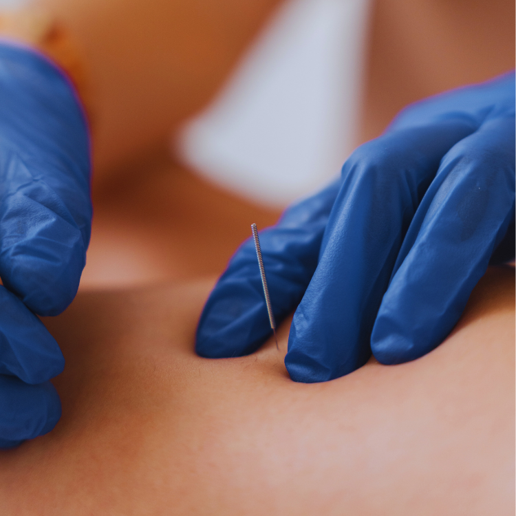 Dry needling. Fysiotherapie. Fysio en Motion