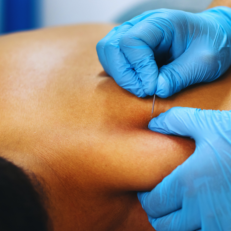 Dry needling. Fysiotherapie. Fysio en Motion
