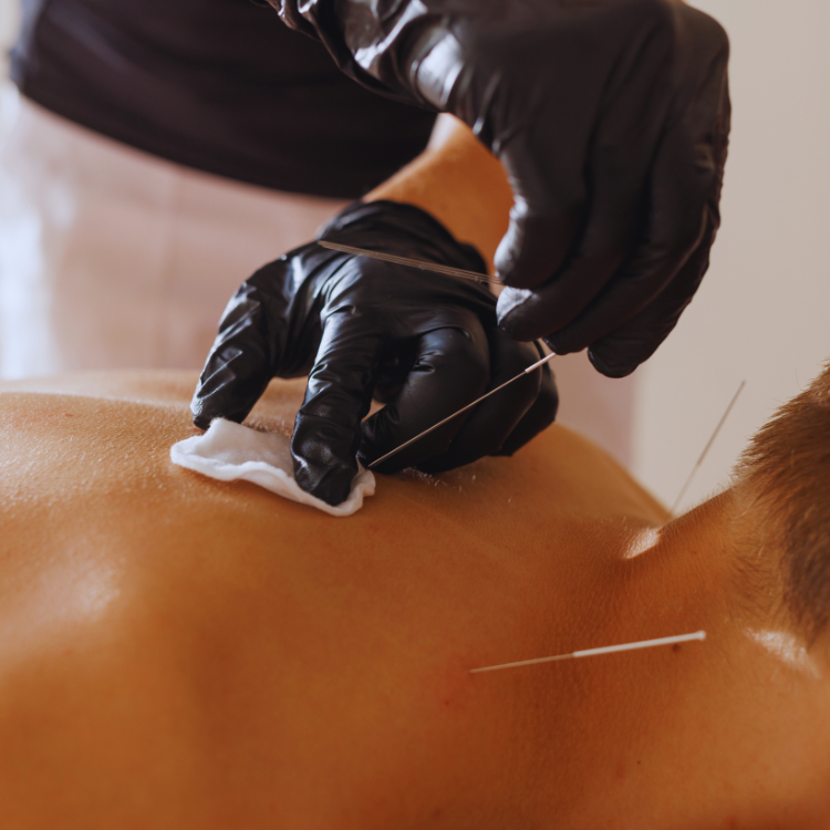 Dry needling. Fysiotherapie. Fysio en Motion